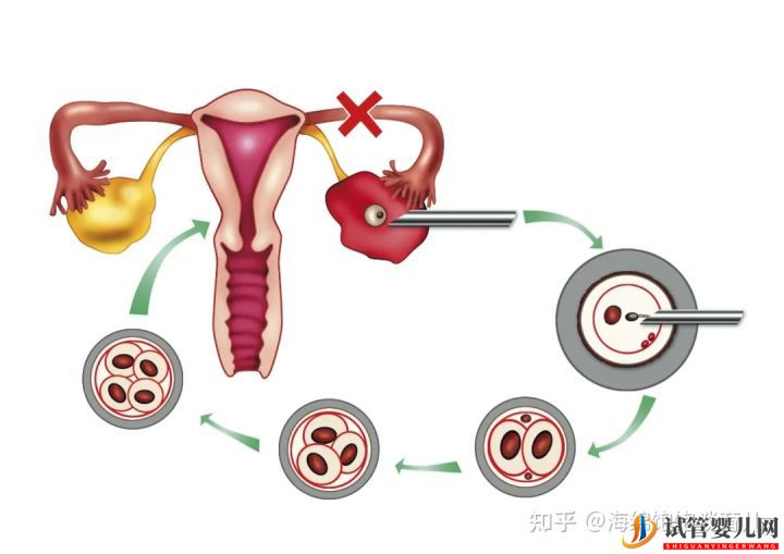 試管嬰兒1代、2代、3代、4代哪個最好(圖2)