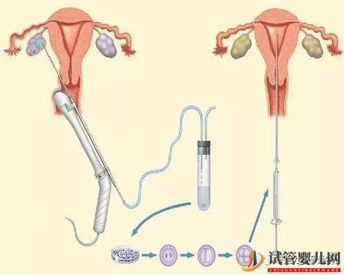 試管嬰兒的一個基本流程和周期時間(圖3)
