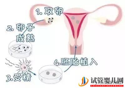 試管嬰兒的一個基本流程和周期時間(圖1)