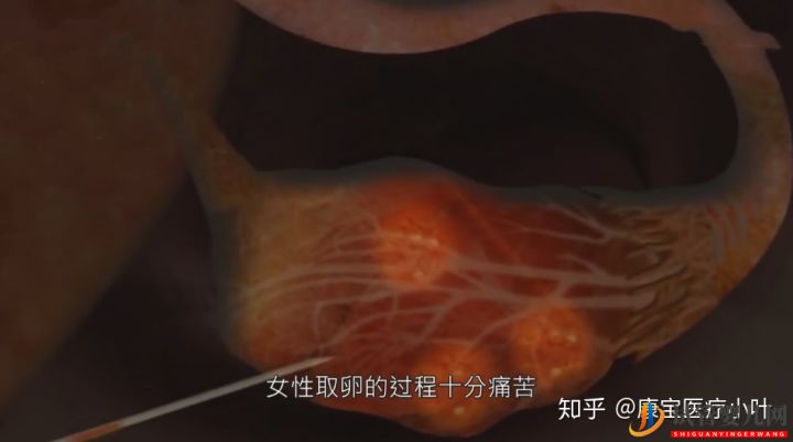 做試管嬰兒有多痛,幾張3D模擬圖,看完全過程后心(圖2)