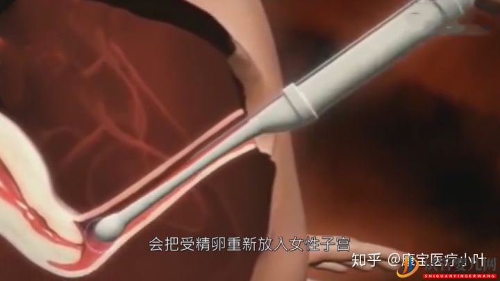 做試管嬰兒有多痛,幾張3D模擬圖,看完全過程后心(圖8)
