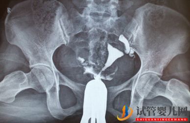 做試管嬰兒基因篩選是怎么的一回事？(圖1)