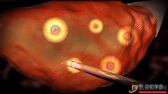 美國試管嬰兒方案制定依據(jù)各環(huán)節(jié)具體操作及重點(diǎn)(圖6) 美國試管嬰兒方案制定依據(jù)各環(huán)節(jié)具體操作及重點(diǎn)(圖6)