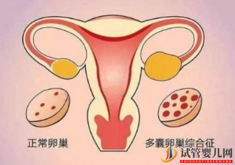 多囊卵巢綜合征對試管嬰兒有什么影響(圖1)