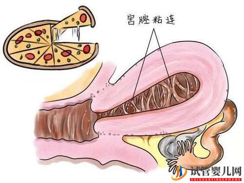 子宮粘連可以做試管嬰兒嗎？成功率高不高？(圖1)