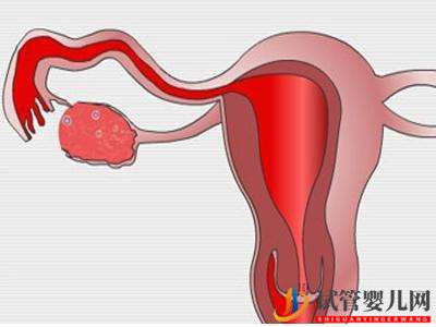 子宮肌瘤做俄羅斯試管嬰兒的成功率高嗎？(圖1)