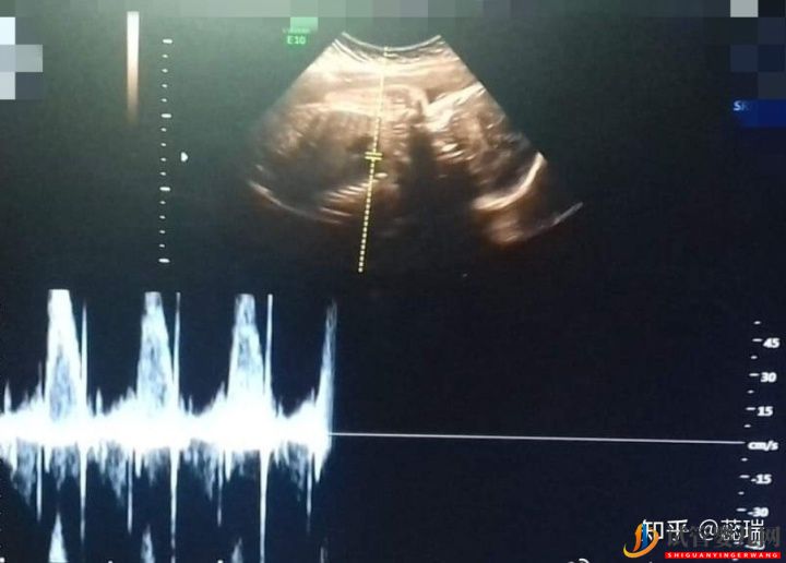 我終于懷上了!辛酸三代試管經歷!大家接好孕!(圖2)