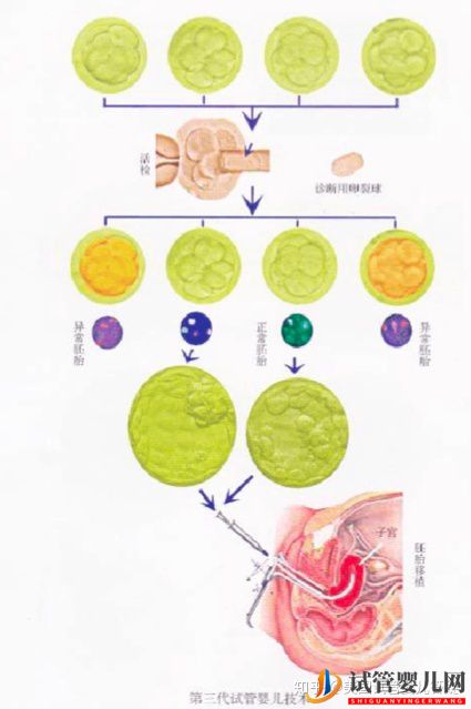 到底要不要去美國做試管嬰兒(試管嬰兒多少錢)(圖1) 到底要不要去美國做試管嬰兒(圖1)