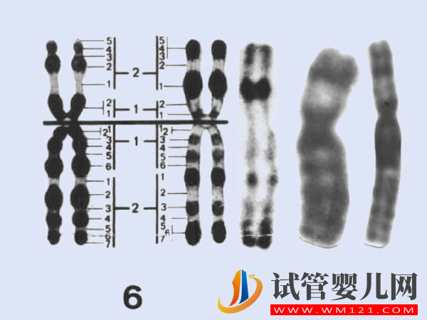 6號染色體缺失、重復相關疾病匯總，不同異常對寶寶影響不一(圖1)