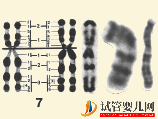 7號染色體異常真不是騙局，出現三體、偏多孩子會有這些疾病(圖1)