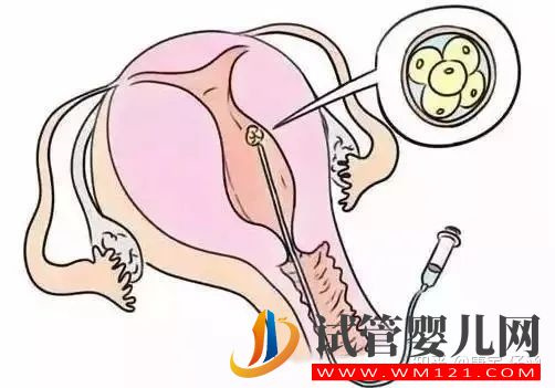 云浮試管嬰兒有關(guān)“胚胎移植”的問題解答(圖1)