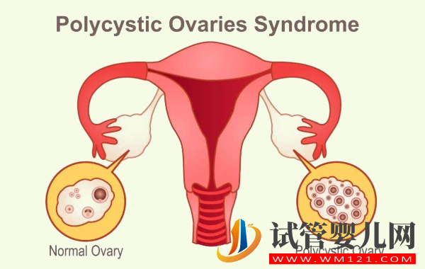 多囊卵巢服用維生素E的正確吃法:從月經(jīng)期開始對(duì)身體有好處(圖1) 多囊卵巢服用維生素E的正確吃法:從月經(jīng)期開始對(duì)身體有好處(圖1)