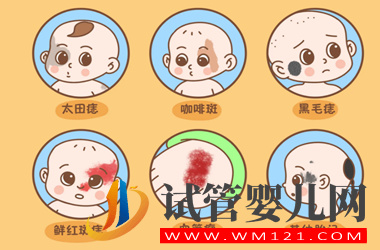 胎記遺傳的可能性大嗎?試管嬰兒會(huì)長(zhǎng)胎記嗎?(圖2)