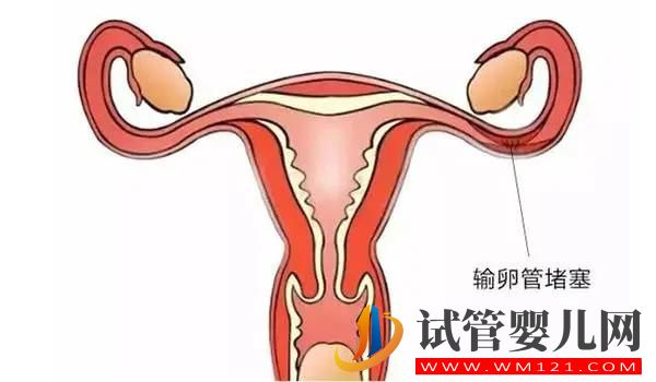 你了解輸卵管阻塞嗎？原因/癥狀/影響(圖1)