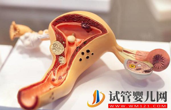 子宮腺肌癥打達菲林頻率有講究，效果好不好看看就知道(圖1)