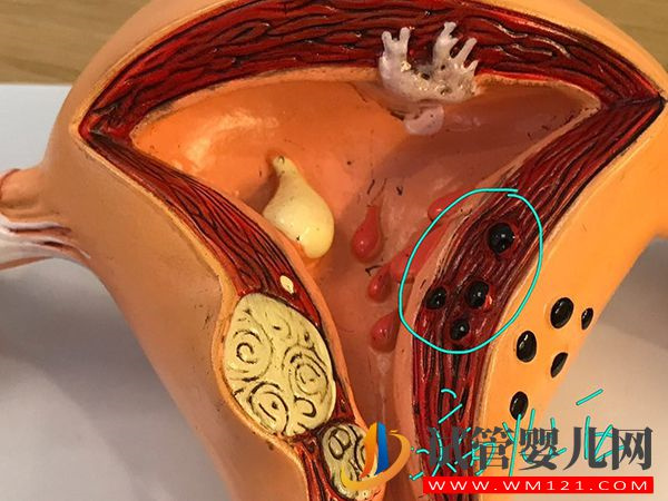 子宮腺肌癥打達菲林頻率有講究，效果好不好看看就知道(圖3)