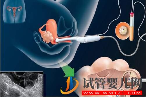 人工授精和試管嬰兒的區(qū)別及手術(shù)費(fèi)用是多少?(圖2) 和田人工授精和試管嬰兒的區(qū)別及手術(shù)費(fèi)用是多少?(圖2)