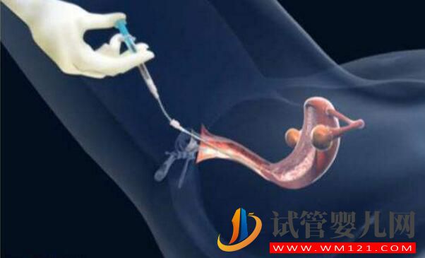 人工授精多次失敗后還可以做試管嬰兒嗎?(圖3)