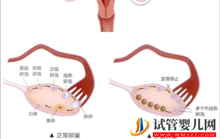 多優勢卵泡形成原因解析，濫用促排藥占很大部分(圖1)
