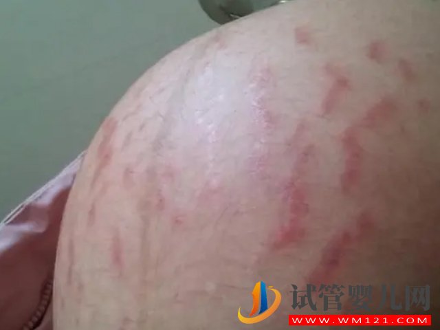 妊娠線粗細、長短都已暗示生男生女，不同性別區別真的很大(圖2)