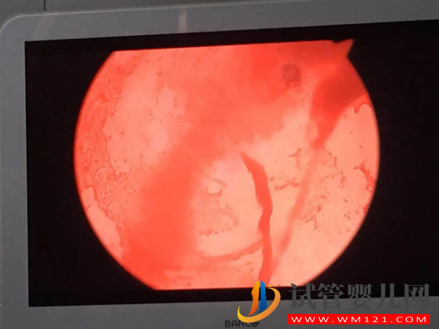 二胎38周剖腹產后遺癥太多！產后每天都在后悔(圖3)