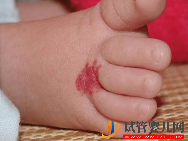 兒童不同位置胎記圖解大全，是福是禍點(diǎn)看看了才知道(圖1)