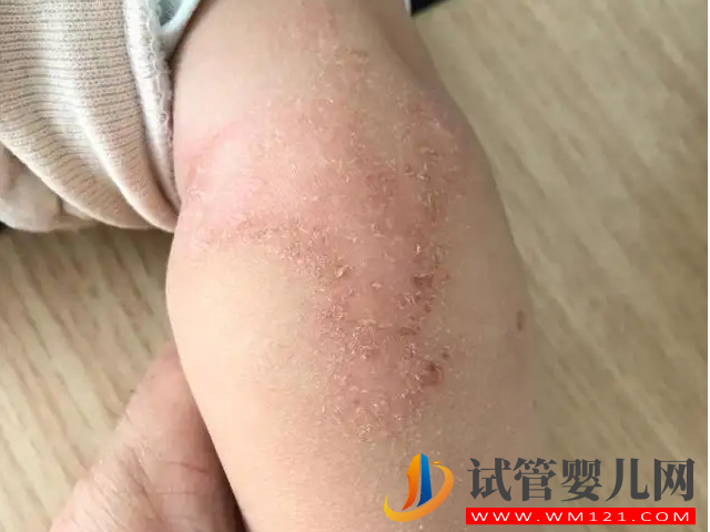 新生兒臉上冒濕疹不用慌,家庭護理小妙招輕松處理(圖2) 新生兒臉上冒濕疹不用慌,家庭護理小妙招輕松處理(圖2)