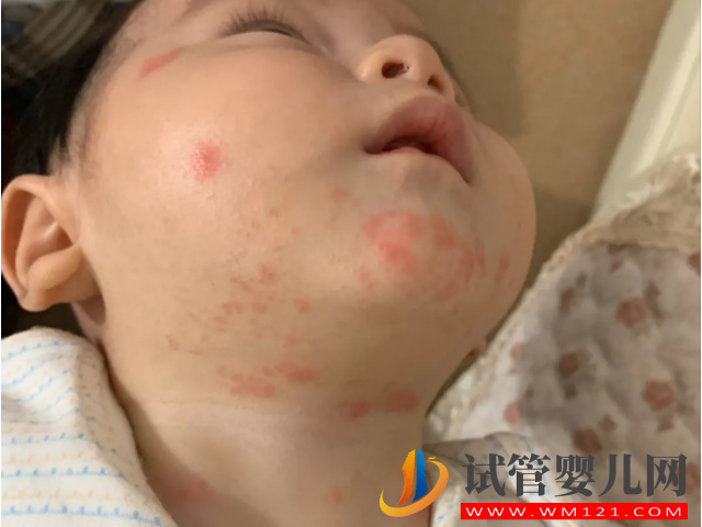 新生兒臉上冒濕疹不用慌,家庭護理小妙招輕松處理(圖3) 新生兒臉上冒濕疹不用慌,家庭護理小妙招輕松處理(圖3)