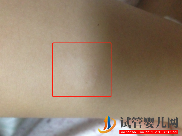 新生兒白色胎記圖片大全，發(fā)病幾率小但危害大(圖1)
