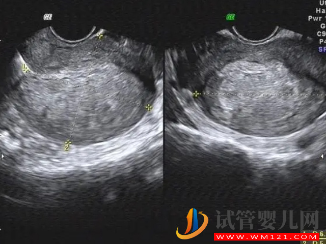 子宮內(nèi)膜薄做試管攻略分享,選對適合試管技術(shù)為首要條件(圖3) 子宮內(nèi)膜薄做試管攻略分享,選對適合試管技術(shù)為首要條件(圖3)