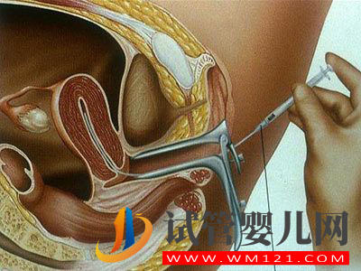 人流后發生不孕不育可以做試管嬰兒嗎?(圖1)