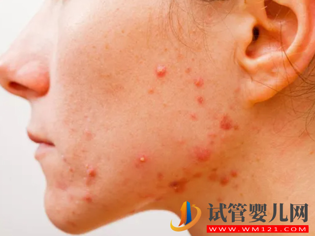 女性多囊長痘和普通長痘有區別,外在表現和癥狀都不一樣(圖2) 女性多囊長痘和普通長痘有區別,外在表現和癥狀都不一樣(圖2)