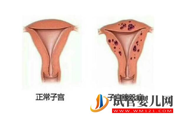 子宮腺肌癥能做試管嬰兒嗎？應該如何備孕(圖1)