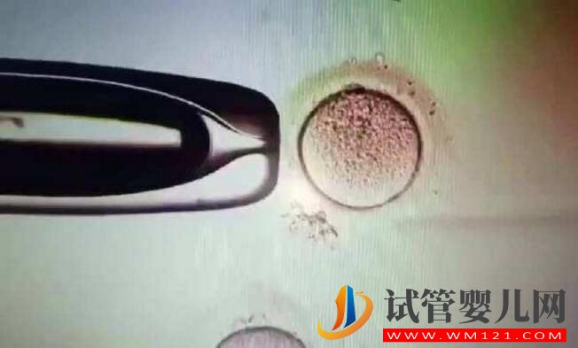 子宮腺肌癥能做試管嬰兒嗎？應該如何備孕(圖4)
