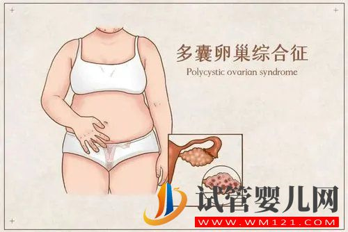 多囊卵巢的原因有哪些？(圖1)