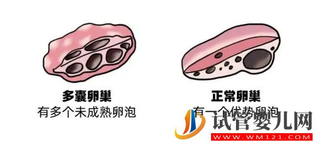 多囊卵巢有這些表現(xiàn)(圖1)