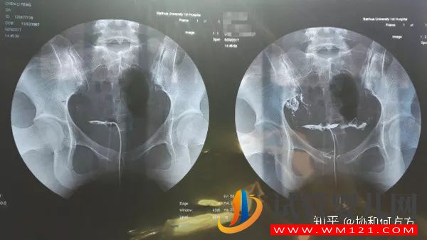 輸卵管造影片的解讀,你理解對了嗎(圖1)
