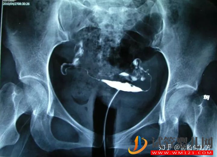 輸卵管造影片的解讀,你理解對了嗎(圖6) 輸卵管造影片的解讀,你理解對了嗎(圖6)
