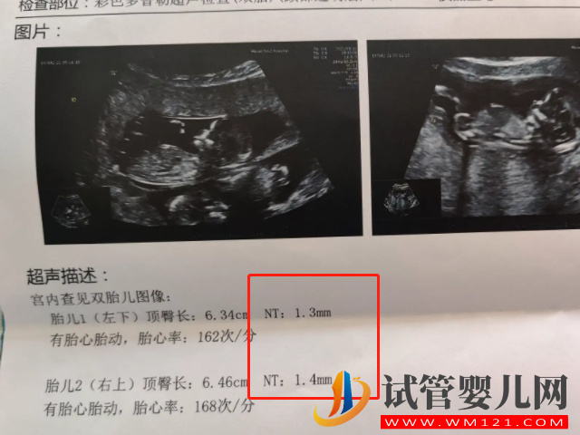 孕13周NT男孩女孩區別圖，內附已生寶媽們nt值作參考(圖2)