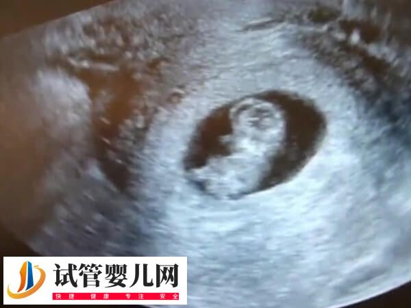 試管嬰兒檢查NT會不會有問題(圖1)